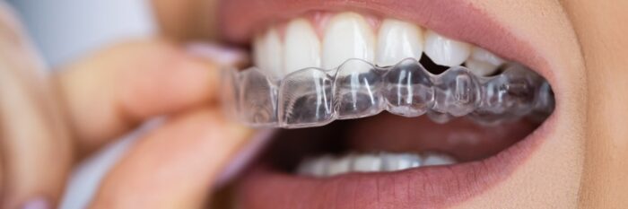 Orthodontics in Ogden Hoopes Dental, Dentist in Ogden UT, Dr. Gary Hoopes, Dr. Brett Hoopes, Dental Implants, All-on-X Dental Implants, Dentures, Invisalign, clear aligners, Sleep Apnea therapy treatment, Orthodontics, Botox, PRP, Cosmetic, Family Dentistry in Ogden, UT. TMJ, TMD, Implants, Teeth Whitening, Cerec Same-Day Crowns, Sedation Dentistry, Restorative Dentistry, Dental Implants, Wisdom Teeth Extractions, Root Canal Therapy, Sedation Dentistry, Cosmetic Dentistry, Restorative Dentistry, Sleep Apnea Treatment, Emergency Dental Services, Dentures, Dental cleanings, dental exams, family dentistry, general dentistry, children's dentistry, dental sealants, fluoride treatment, gum disease treatment therapy, periodontal maintenance, porcelain dental veneers, Dental crowns, dental bridges, dental bonding, smile makeover, clear aligners, traditional metal braces, orthodontics in Ogden, Dentist in Ogden UT, Full Mouth Rehabilitation, Gum therapy treatment, dental x-rays, laser dentistry, oral moderate sedation, IV sedation, Nitrous Oxide Sedation dentistry, tooth-colored fillings, Emergency Dentistry All-on-4 Dental Implants, oral surgery, dentist in Ogden, dentist near me Ogden, Orthodontist in Ogden UT, EXISTING PATIENTS 801-399-9470, NEW PATIENTS 801-657-3710, 333 2ND ST. SUITE 1A, OGDEN, UT 84404